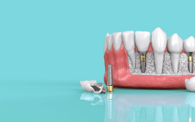 Имплантация зубов при дефиците тканей