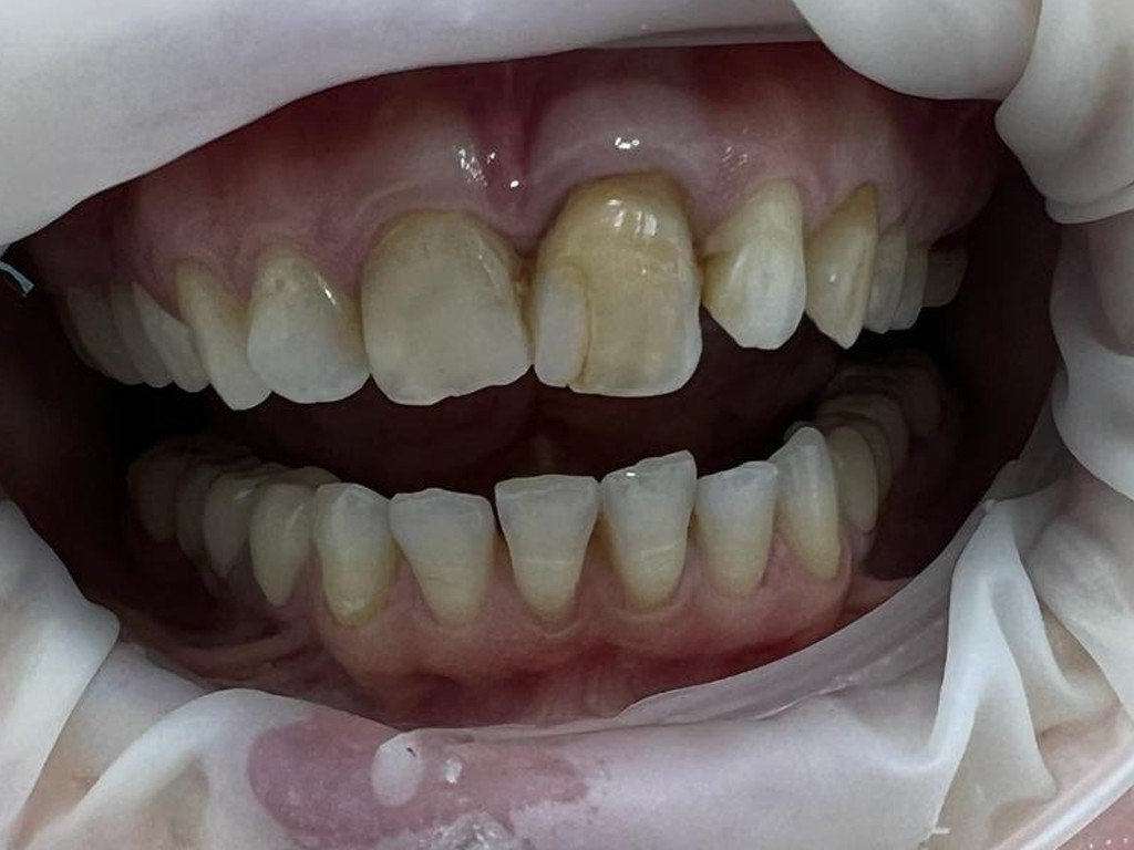 Зубы до реставрации