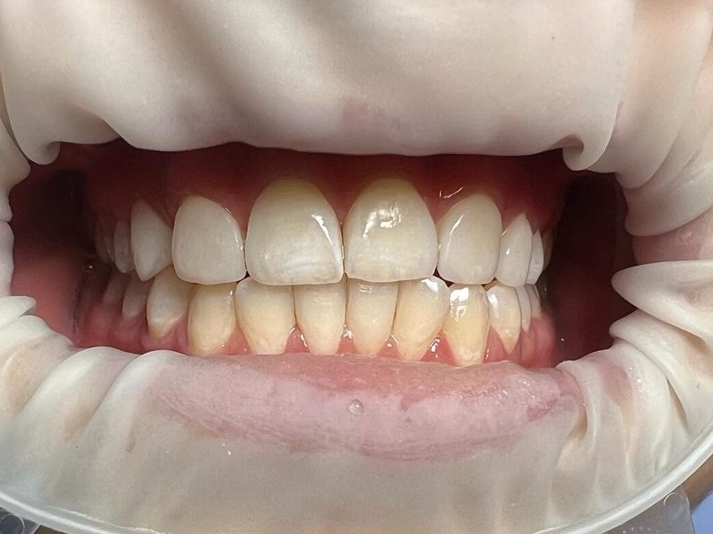 Зубы после реставрации
