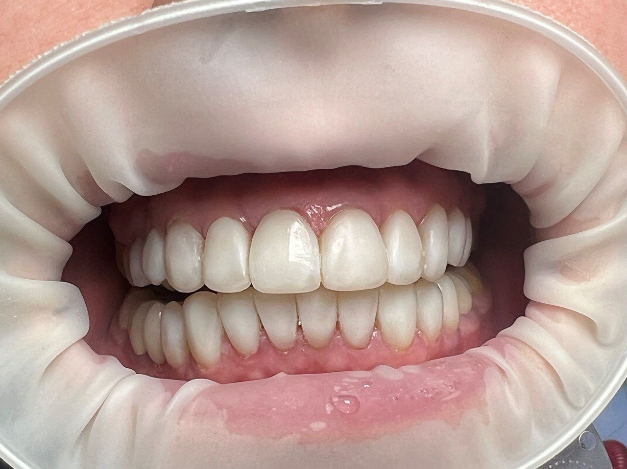 Зубы после реставрации